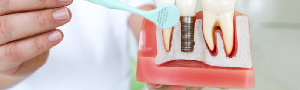 Male Dentist Explaining Tooth Implantation Male Dentist Explaining Tooth Implantation