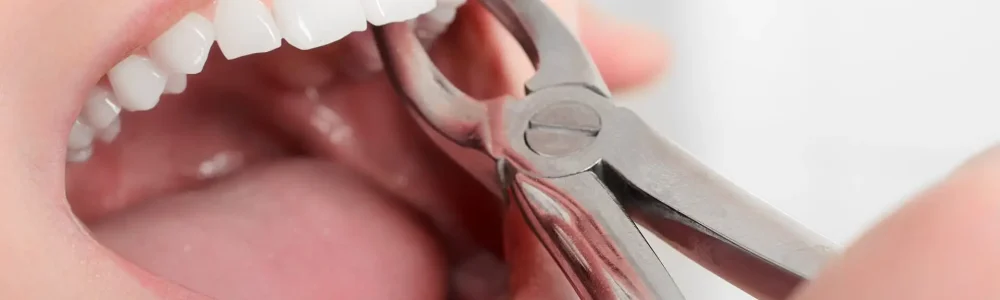tooth-extraction-blog-1